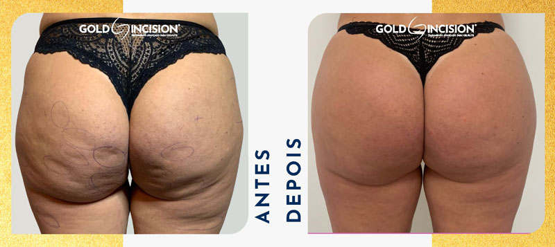 Antes e depois tratamento da Celulite com goldincision